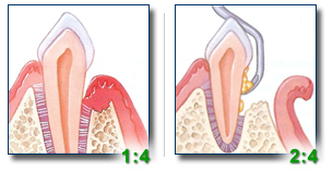 Dr. Hogan, Osseous Surgery, Columbia Periodontist, South Carolina, SC